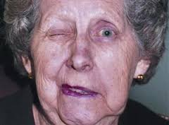 دکتر حسین ارجمند, همی فاشیال اسپاسم, شیراز, بوتاکس, hemifacial spasm, botox دکتر حسین ارجمند, همی فاشیال اسپاسم, شیراز, بوتاکس, hemifacial spasm, botox